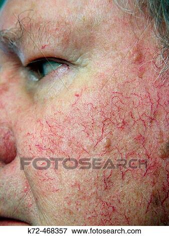 Blood Veins on Old Man's Face View Large Photo Image Stock Photo - Blood Veins on Old Man's Face. Fotosearch