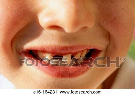Stock Image - Boy missing tooth. Fotosearch