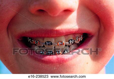 boy with braces View Large Photo Image Stock Image - boy with braces. Fotosearch
