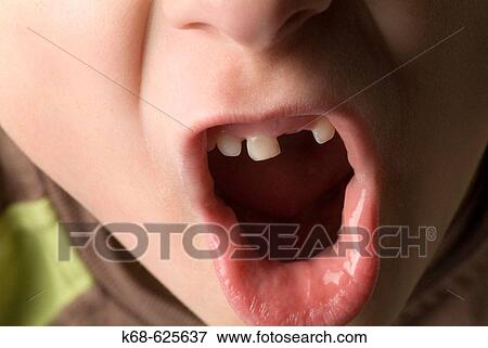 Boy's mouth, missing tooth, 7 years old View Large Photo Image Stock Photo - Boy's mouth, missing tooth, 7 years old. Fotosearch