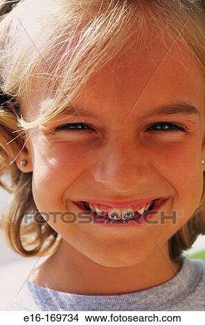 Braces on girl View Large Photo Image Picture - Braces on girl. Fotosearch