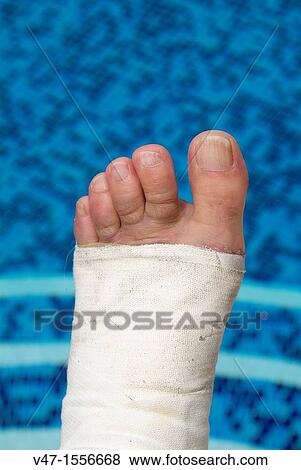 broken foot, Carcaixent, Valencia, Spain, Europe View Large Photo Image Stock Photo - broken foot, Carcaixent, Valencia, Spain, Europe. Fotosearch
