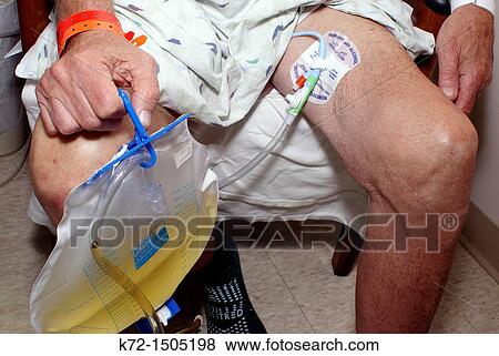 Catheter with holding bag View Large Photo Image Stock Photo - Catheter with holding bag. Fotosearch