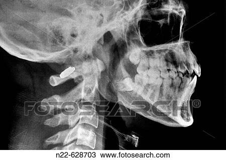 Cervical vertebrae X-ray. View Large Photo Image Stock Image - Cervical vertebrae X-ray.. Fotosearch