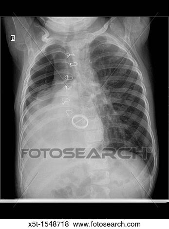 Stock Photo - Chest X-ray of a 2 year old infant with Pneumonia. Fotosearch