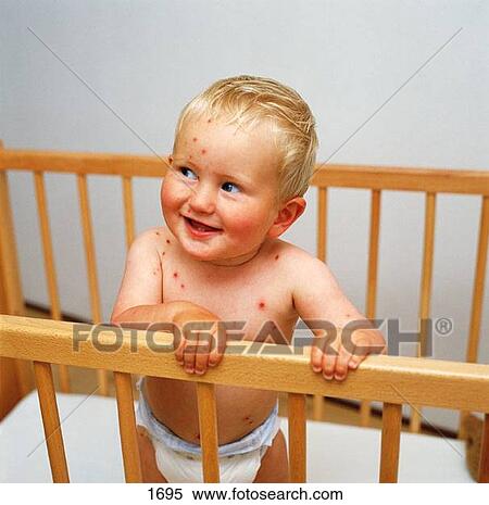 Chicken Pox View Large Photo Image Stock Photography - Chicken Pox. Fotosearch