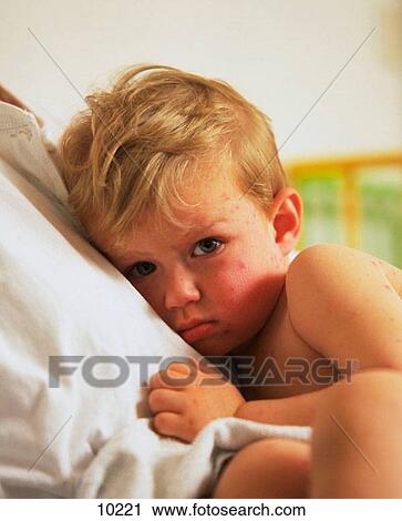 Chickenpox View Large Photo Image Stock Image - Chickenpox. Fotosearch