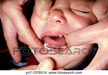 close up of a dentist's fingers probing an upset child's mouth View Large Photo Image Picture - close up of a dentist's fingers probing an upset child's mouth. Fotosearch