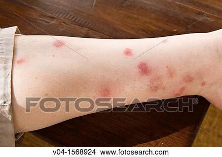 Picture - Close up of a leg covered in mosquito bites, Tanzania, Africa. Fotosearch