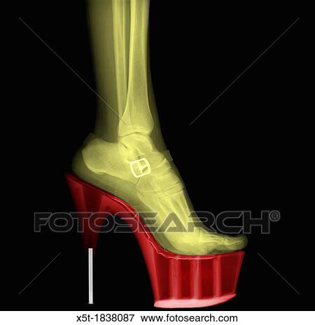 Stock Photo - Coloured X-ray of a woman leg wearing Stiletto High-Heeled Shoe. Fotosearch