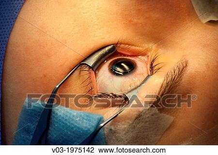 Corrective Eye Surgery View Large Photo Image Stock Image - Corrective Eye Surgery. Fotosearch