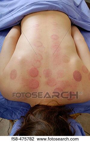Cupping View Large Photo Image Stock Image - Cupping. Fotosearch