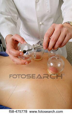 Cupping View Large Photo Image Stock Photo - Cupping. Fotosearch