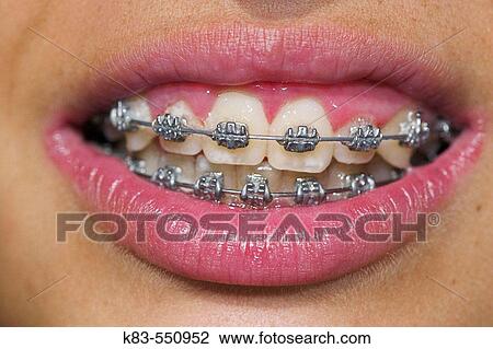 Dental braces View Large Photo Image Stock Image - Dental braces. Fotosearch