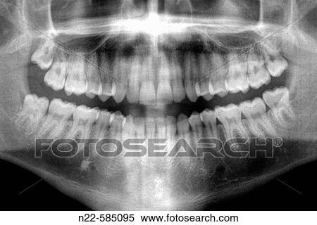 Dental X-ray View Large Photo Image Stock Photography - Dental X-ray. Fotosearch