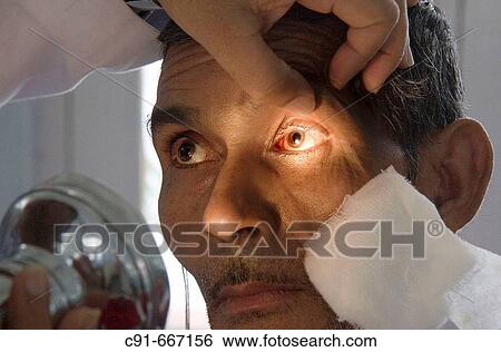 Eye examination after cataract surgery in hospital, Renukoot. Uttar Pradesh, India View Large Photo Image Stock Photograph - Eye examination after cataract surgery in hospital, Renukoot. Uttar Pradesh, India. Fotosearch