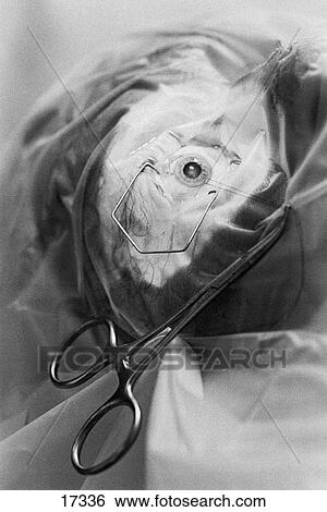 Eye surgery View Large Photo Image Stock Photograph - Eye surgery. Fotosearch