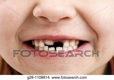 girl 7 with tooth missing detail View Large Photo Image Picture - girl 7 with tooth missing detail. Fotosearch