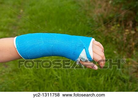 Girl has her arm in a plaster having broken the bone View Large Photo Image Stock Photo - Girl has her arm in a plaster having broken the bone. Fotosearch