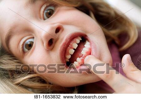 Girl pointing chipped teeth, View Large Photo Image Stock Image - Girl pointing chipped teeth,. Fotosearch