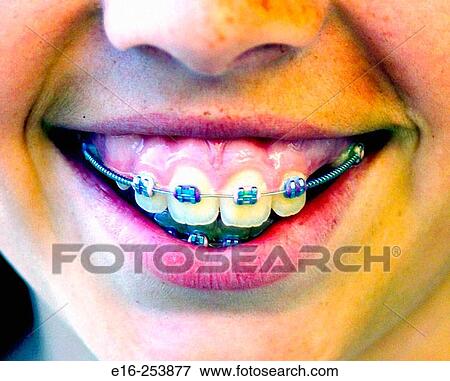 girl with braces View Large Photo Image Stock Photo - girl with braces. Fotosearch
