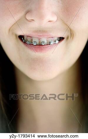 Picture - Girl with irons on teeth. Fotosearch