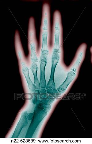 Hand bones X-ray. View Large Photo Image Stock Photo - Hand bones X-ray.. Fotosearch