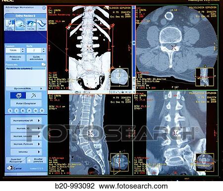 Stock Image - HD(high-definition) scan of spine, CAT, medical imaging for diagnosis. Hospital Policlinica Gipuzkoa, San Sebastian, Donostia, Euskadi, Spain. Fotosearch