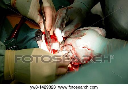 Stock Image - Heart bypass surgery, Reykjavik Iceland. Fotosearch