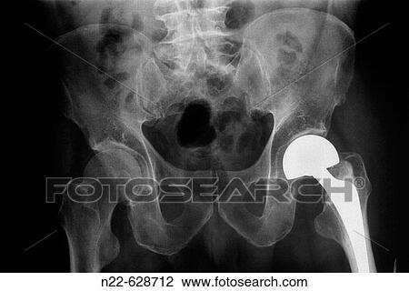 Stock Image - Hip prosthesis.. Fotosearch
