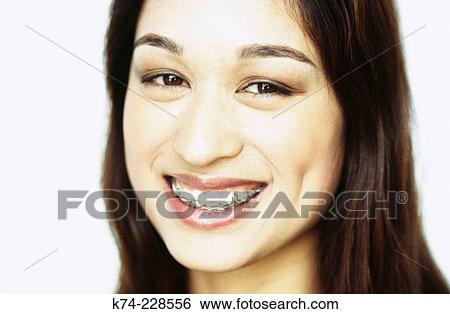 Stock Photograph - image of young woman with braces, smiling. Fotosearch