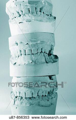 Impression Mold of Teeth View Large Photo Image Stock Image - Impression Mold of Teeth. Fotosearch