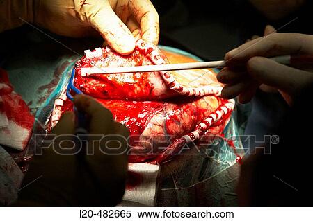 Intracranial surgery, cerebral hemorrhage due traumatic brain injury. Hospital Universitario Gran Canaria Doctor Negrin, Las Palmas de Gran Canaria. Canary Islands, Spain View Large Photo Image Stock Photography - Intracranial surgery, cerebral hemorrhage due traumatic brain injury. Hospital Universitario Gran Canaria Doctor Negrin, Las Palmas de Gran Canaria. Canary Islands, Spain. Fotosearch