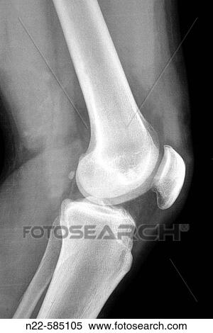 Knee X-ray View Large Photo Image Stock Photography - Knee X-ray. Fotosearch
