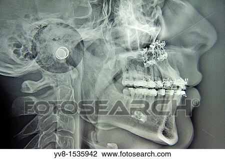 Maxillofacial Surgery View Large Photo Image Stock Image - Maxillofacial Surgery. Fotosearch