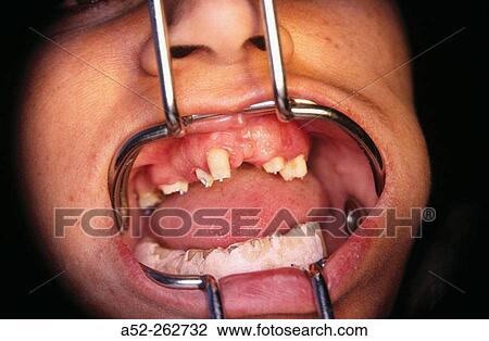 Open mouth showing teeth defects at a dentists clinic. View Large Photo Image Stock Image - Open mouth showing teeth defects at a dentists clinic.. Fotosearch