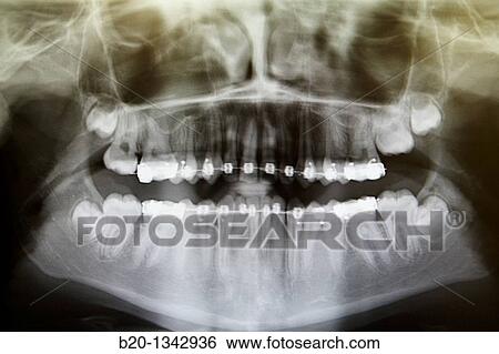 Orthodontics, dental clinic, Eibar, Gipuzkoa, Euskadi, Spain View Large Photo Image Stock Photograph - Orthodontics, dental clinic, Eibar, Gipuzkoa, Euskadi, Spain. Fotosearch