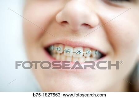 Stock Image - ortodoncia, primer plano de boca de chica adolescente con aparatos en los dientes, Orthodontics, mouth foreground teenage girl with braces on teeth,. Fotosearch