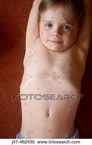 Outstretched 3 year old girl smiling into camera covered in chickenpox View Large Photo Image Stock Photography - Outstretched 3 year old girl smiling into camera covered in chickenpox. Fotosearch
