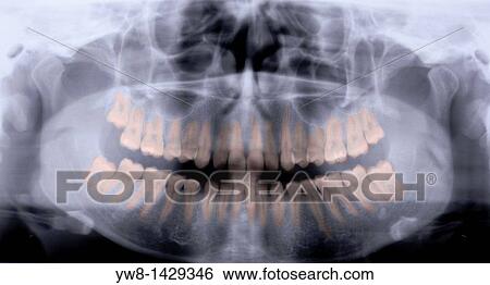 Panoramic X-Ray of Mouth View Large Photo Image Stock Photograph - Panoramic X-Ray of Mouth. Fotosearch