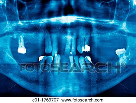Panorex OPG Orthopantomogram mouth and theeth radiography View Large Photo Image Stock Photo - Panorex OPG Orthopantomogram mouth and theeth radiography. Fotosearch