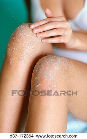 Picture - Peeling. Fotosearch