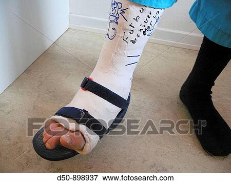 Plaster cast on an eight year old boy. Broken ankle. View Large Photo Image Stock Photo - Plaster cast on an eight year old boy. Broken ankle.. Fotosearch