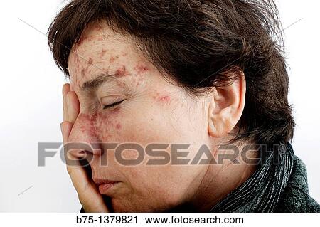 Portrait of woman with skin spots View Large Photo Image Stock Image - Portrait of woman with skin spots. Fotosearch
