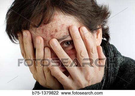 Stock Image - Portrait of woman with skin spots. Fotosearch