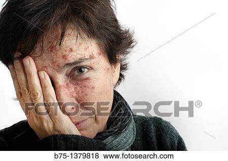 Portrait of woman with skin spots View Large Photo Image Stock Photo - Portrait of woman with skin spots. Fotosearch