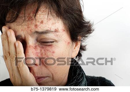 Stock Photo - Portrait of woman with skin spots. Fotosearch