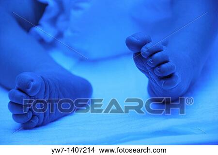 Premature baby with jaundice having phototherapy View Large Photo Image Picture - Premature baby with jaundice having phototherapy. Fotosearch