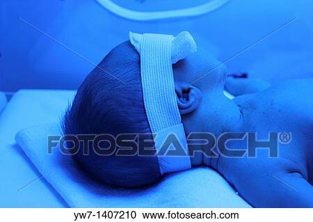 Premature baby with jaundice having phototherapy View Large Photo Image Stock Image - Premature baby with jaundice having phototherapy. Fotosearch