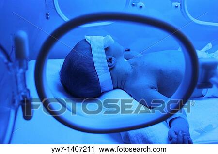 Premature baby with jaundice having phototherapy View Large Photo Image Stock Image - Premature baby with jaundice having phototherapy. Fotosearch